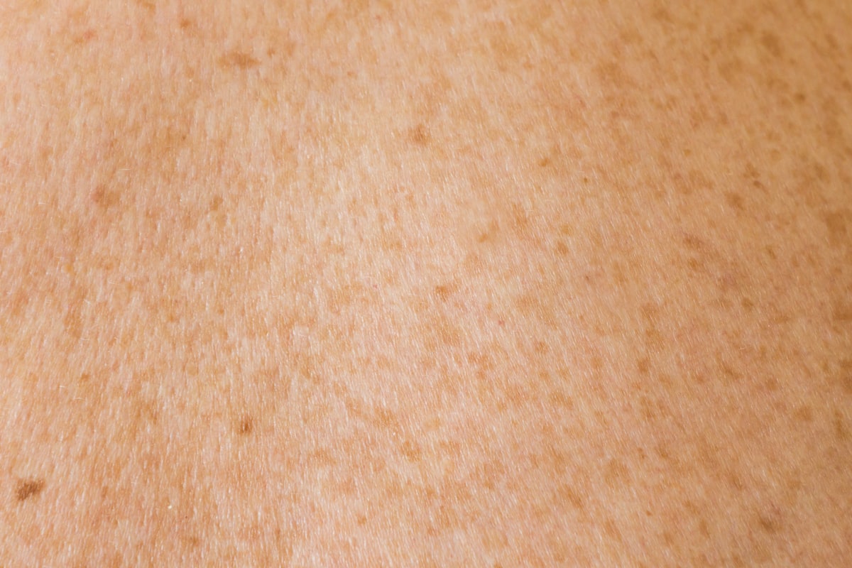 Ingredientes naturales para aclarar manchas